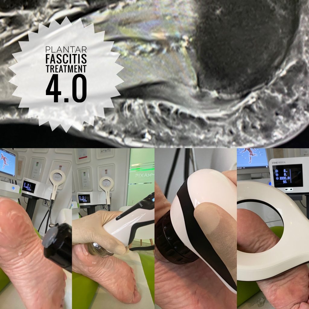 Plantar Fascitis treatment